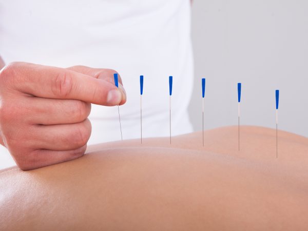 Young Beautiful Woman In An Acupuncture Therapy In A Spa Center
