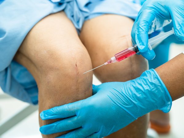 Asian,Doctor,Inject,Hyaluronic,Acid,Platelet,Rich,Plasma,Into,The